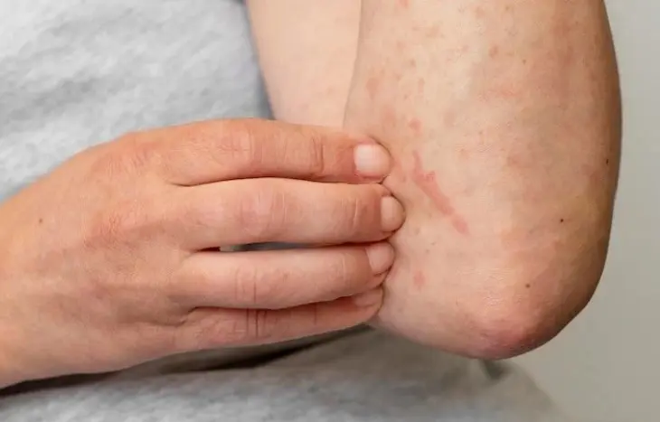 Cara Menghilangkan Gatal pada Kulit: Penyebab, Perawatan, dan Tips Efektif